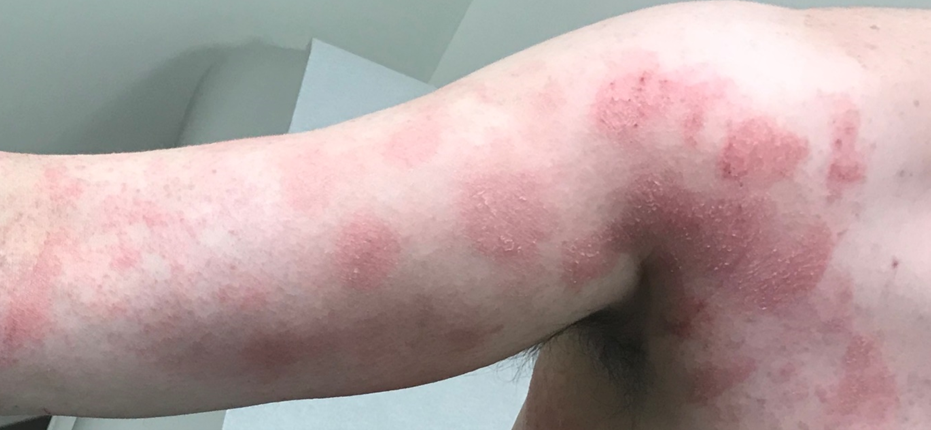 What is Causing My Rash?  The Challenge of Allergic Contact Dermatitis.